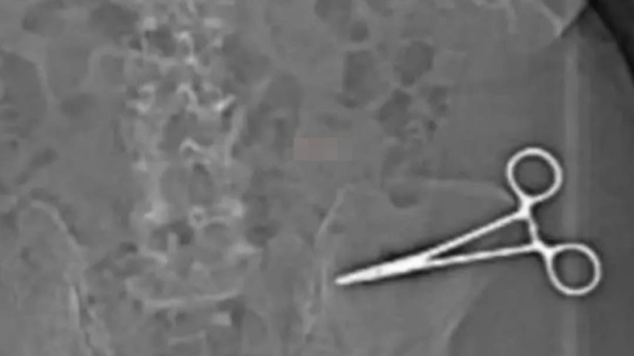 La paciente, de 53 años, sufrió fuertes dolores, infecciones y desmayos hasta que una tomografía reveló que tenía un instrumento médico de 15 centímetros olvidado en su cuerpo luego de una abdominoplastia.