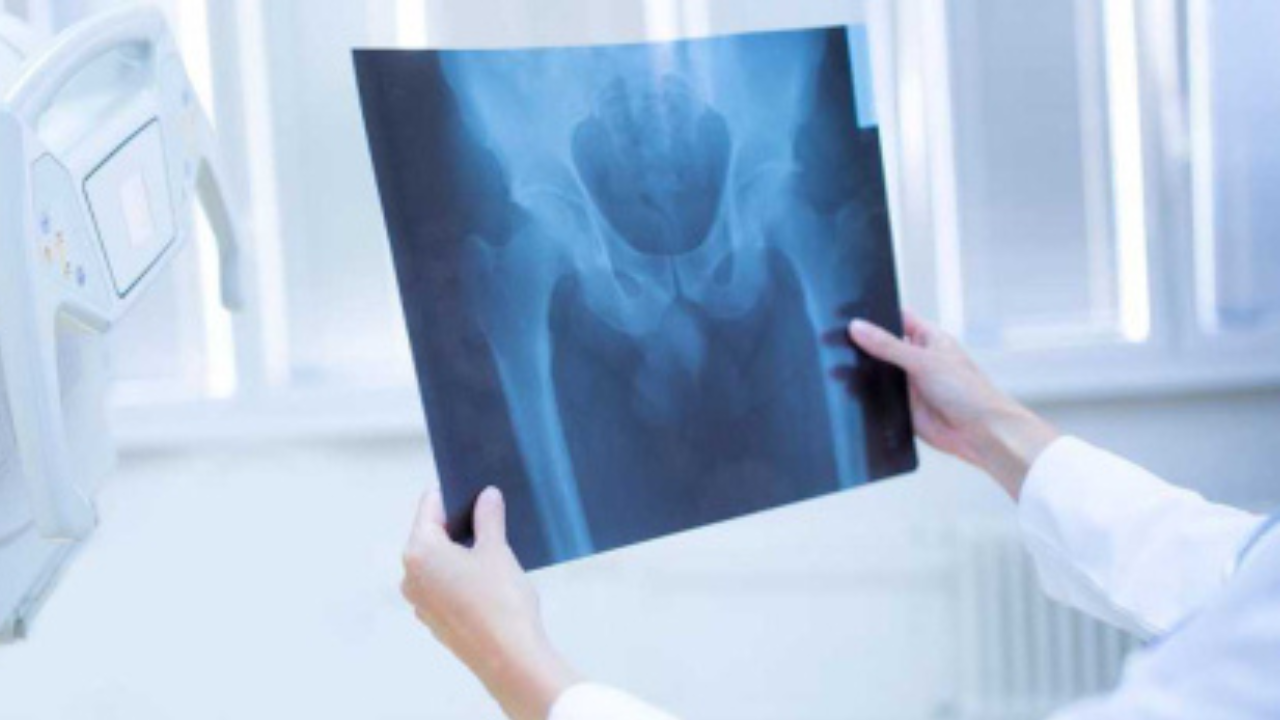 Una mujer de Roca sufrió una fractura de cadera al caer en el cumpleaños de su nieta. La Justicia ordenó al salón pagarle una indemnización millonaria por los daños.